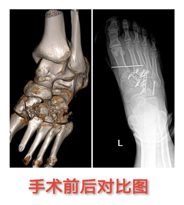 市五院成功开展两例复杂性骨外科手术