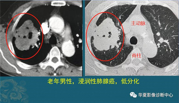 磨玻璃肺结节随访观察，会不会变成肺癌？带你看随访4种结局
