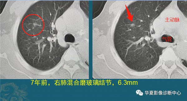 磨玻璃肺结节随访观察，会不会变成肺癌？带你看随访4种结局
