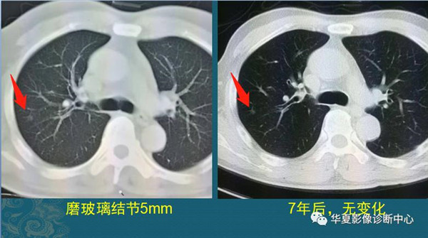 磨玻璃肺结节随访观察，会不会变成肺癌？带你看随访4种结局