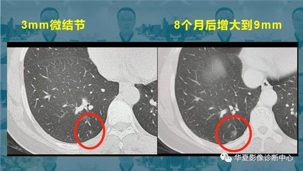 磨玻璃肺结节随访观察，会不会变成肺癌？带你看随访4种结局