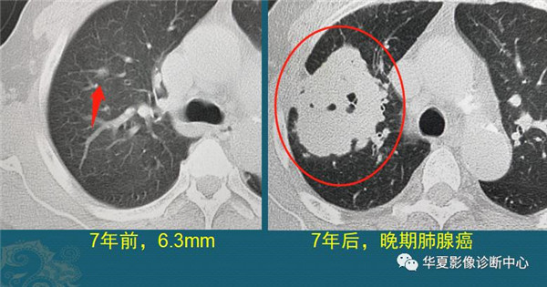 磨玻璃肺结节随访观察，会不会变成肺癌？带你看随访4种结局