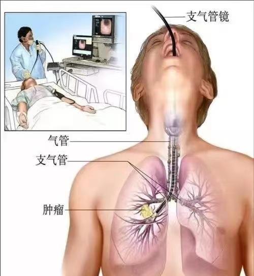 无痛诊疗  让患者受益——市五院熟练开展无痛支气管镜技术