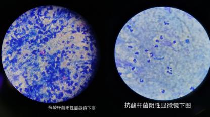 “抗酸杆菌痰涂片检查”知多少？