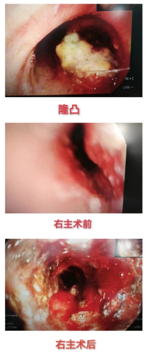 市五院开展一例全麻下经硬质支气管镜结合软镜肿瘤消融术