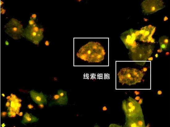 【健康科普】带你认识“线索细胞”