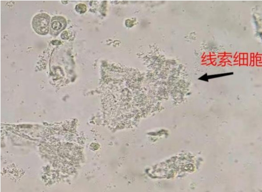【健康科普】带你认识“线索细胞”